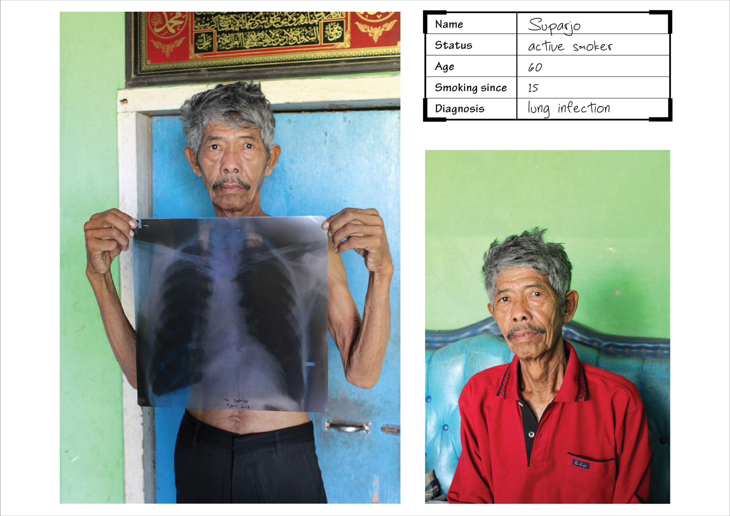 Suparjo shows his x-ray when he was diagnosed with lung infection. He was a smoker but stopped after the disease. Photo by: Niken Yuliana as part of the Photo Story on Tobacco Control Workshop in Yogyakarta, Indonesia (2018)